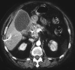 Gallbladder Cancer Simulates A Pancreatic Cancer - CTisus CT Scan