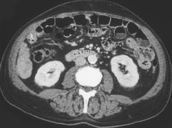 Hepatoma in Bottom of Right Lobe of the Liver - CTisus CT Scan