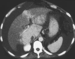 IVC Clot With Budd-Chiari Syndrome - CTisus CT Scan