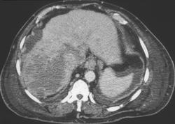 Hepatoma Grows Into the IVC and the Right Atrium - CTisus CT Scan