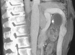 Huge Umbilical Vein - CTisus CT Scan