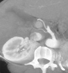 Nice Anatomy of Hepatic Arteries - CTisus CT Scan