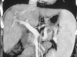 Cirrhosis With Portal Hypertension and Parenchymal Scarring - Liver ...