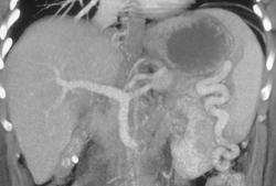 Cirrhosis With Portal Hypertension - CTisus CT Scan