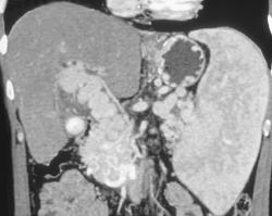 Cavernous Transformation of the Portal Vein - CTisus CT Scan