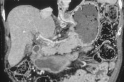 Portal Vein Thrombosis - CTisus CT Scan