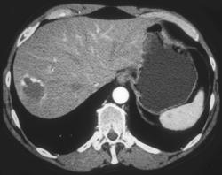 Hemangioma - CTisus CT Scan