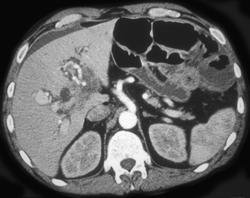 Cholangiocarcinoma in Porta - CTisus CT Scan