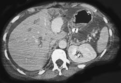 Pseudoaneurysm of A Branch of the Hepatic Artery - CTisus CT Scan