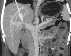 Narrowed Portal Vein Due to Cholangiocarcinoma - CTisus CT Scan