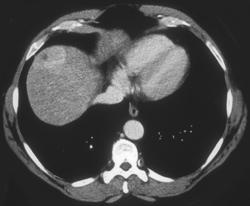 Hepatoma - CTisus CT Scan