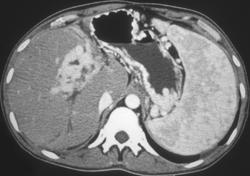 Cirrhosis With Cavernous Transformation of the Portal Vein - CTisus CT Scan