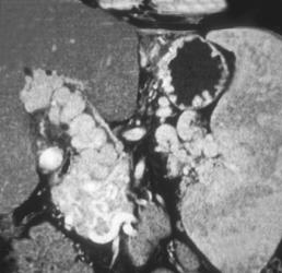 Gastric Varices Due to Portal Hypertension and the Cavernous Transformation of the Portal Vein - CTisus CT Scan