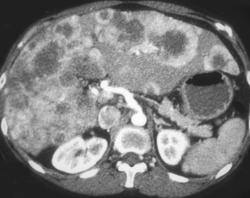 Multifocal Hepatomas - CTisus CT Scan