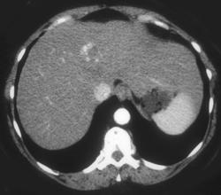 Hemangioma - CTisus CT Scan