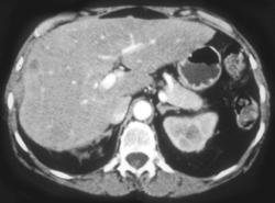 Implants on the Liver - CTisus CT Scan