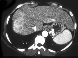 Hepatoma - CTisus CT Scan