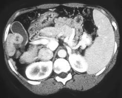 Hepatoma Pushes Into the Gallbladder in This Cirrhotic Patient - CTisus CT Scan