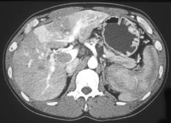 Hepatoma With Flow Changes and Portal Vein (PV) Thrombus - CTisus CT Scan
