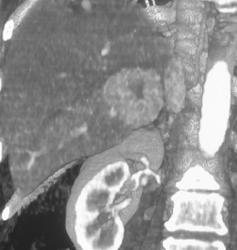 Focal Nodular Hyperplasia and Hemangioma - CTisus CT Scan