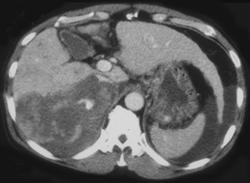 Active Bleed From A Hepatoma - CTisus CT Scan