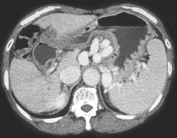 Cirrhosis With Large Varices - CTisus CT Scan