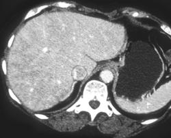 Parenchymal Liver Disease in Hepatitis C Patient - CTisus CT Scan