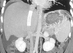 Stent in Inferior Vena Cava (IVC) - CTisus CT Scan