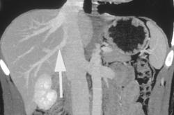 Variant Hepatic Venous Anatomy With Right Hepatic Vein Draining Into IVC - CTisus CT Scan