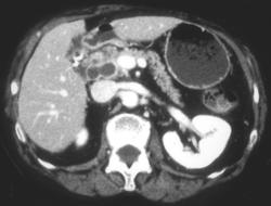 Nodes From Cholangiocarcinoma in Porta Hepatitis - CTisus CT Scan
