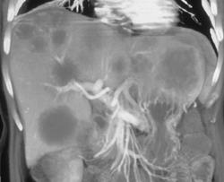 Liver Metastases - CTisus CT Scan