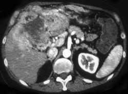 Cholangiocarcinoma - CTisus CT Scan