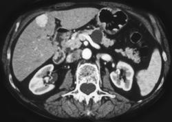 Hepatic Arteriovenous Malformation (AVM) - CTisus CT Scan