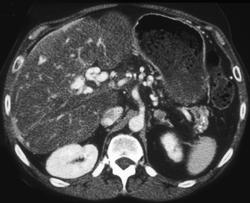 Cavernous Transformation of the Portal Vein - CTisus CT Scan