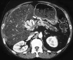 Cavernous Transformation of the Portal Vein. Fatty Liver Seen. - CTisus CT Scan