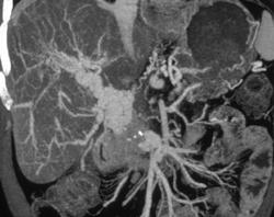 3D of Cavernous Transformation of the Portal Vein - CTisus CT Scan