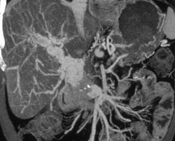 Portal Vein Thrombosis and Cavernous Transformation of the Portal Vein - CTisus CT Scan