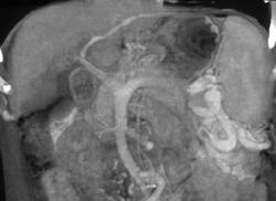 Cirrhosis With Varices - CTisus CT Scan