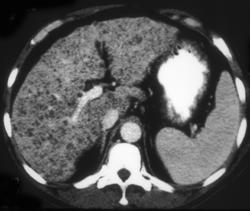 Tuberculosis (TB) of the Liver - CTisus CT Scan