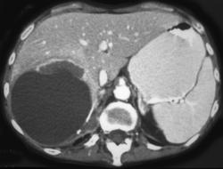 Large Renal Cyst Simulates A Liver Mass - CTisus CT Scan