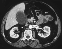 Acute Cholecystitis - CTisus CT Scan