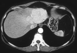 Hepatic Adenoma - CTisus CT Scan