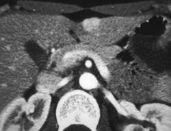 Focal Nodular Hyperplasia - CTisus CT Scan