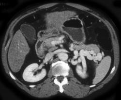 Cirrhosis With Splenorenal Shunting - CTisus CT Scan