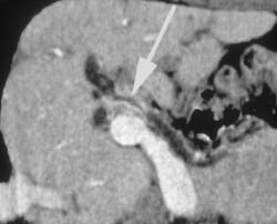 Sclerosing Cholangitis With Thickened Common Duct - CTisus CT Scan