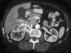 Renal Cell Invades the Inferior Vena Cava (IVC) and Can Simulate A Liver Mass - CTisus CT Scan