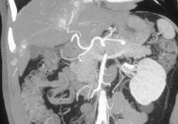 Multifocal Hepatoma - CTisus CT Scan