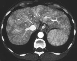 Patchy Enhancement of A Cirrhotic Liver - CTisus CT Scan