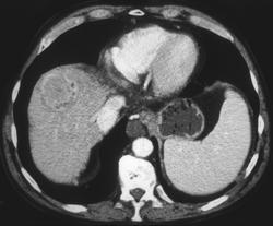 Hepatoma - CTisus CT Scan