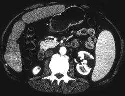 Hepatoma - CTisus CT Scan